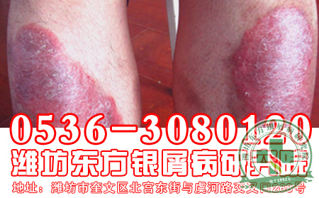 醫(yī)生講述：為什么那么多牛皮癬患者親睞中醫(yī)治療