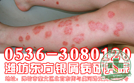 牛皮癬及時(shí)治療很關(guān)鍵