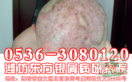 牛皮癬早發(fā)現(xiàn) 早治療