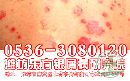 醫(yī)生提醒  牛皮癬治療要適度