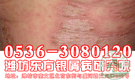 造成銀屑病患者發(fā)病的誘因有哪些?