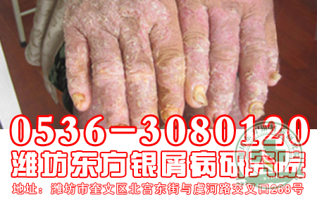 老年人要如何治療牛皮癬？