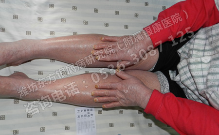 如何防止銀屑病在急性進行期泛發(fā)全身呢