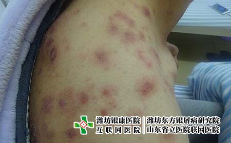 [銀屑病治療都詢濟南]怎么做才能夠有效預防牛皮癬