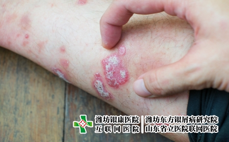 攝圖網(wǎng)_323551465_絲蟲病藥品手臂皮炎宏觀彎頭疾病剝皮醫(yī)療衛(wèi)生身體（企業(yè)商用）
