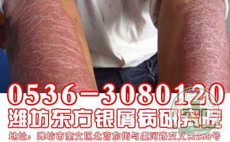 牛皮癬日常護(hù)理一定要注意