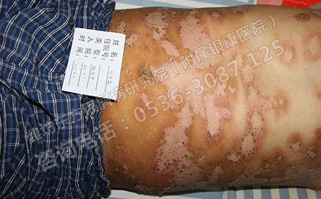 如何避免銀屑病治療的誤區