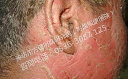 銀屑病是由哪些因素造成的