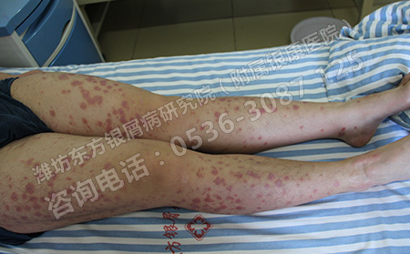 男性銀屑病在治療期間有注意哪些問題