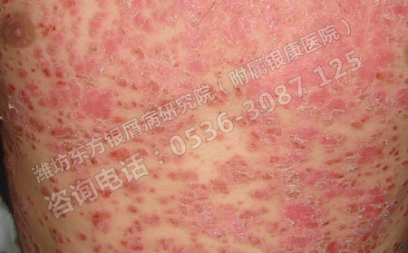 導致銀屑病發生的關鍵因素有哪幾個