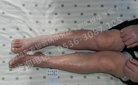 得了銀屑病怎樣護理才能避免復發呢