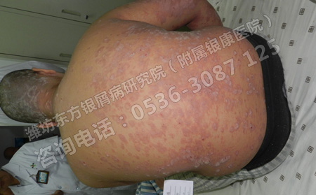 怎樣防止小孩子在日常生活中得銀屑病