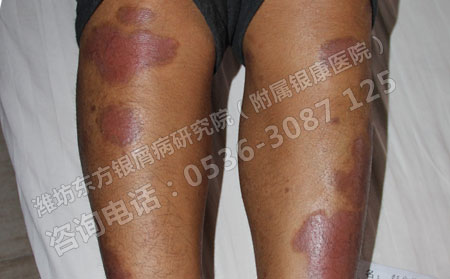 女性牛皮癬患者的夏天護膚方法