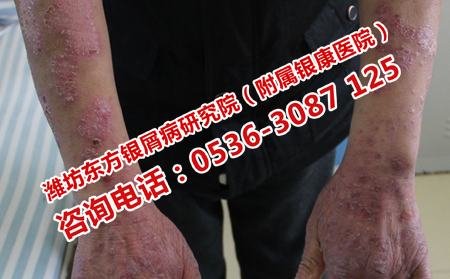 牛皮癬不治療的危害