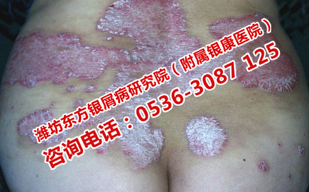 膿皰型牛皮癬的病情發展
