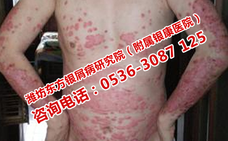 如何護理牛皮癬呢